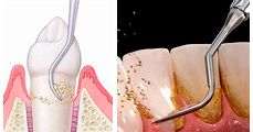 Clínica Dental Noray Internacional periodoncia