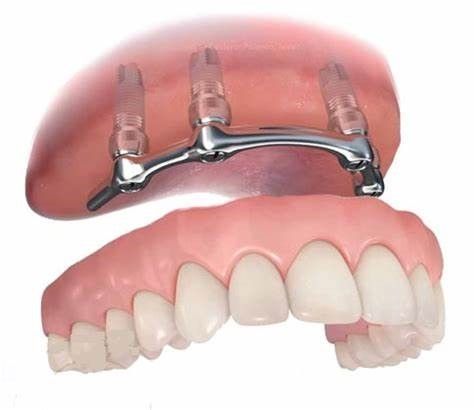Clínica Dental Noray Internacional implante dental