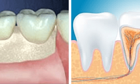 clinica-dental-noray-internacional-endodoncia
