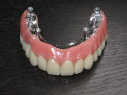 clinica-dental-noray-internacional-protesis4-0