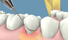 clinica-dental-noray-internacional-periodoncia