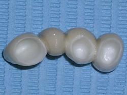 clinica-dental-noray-internacional-protesis1-0