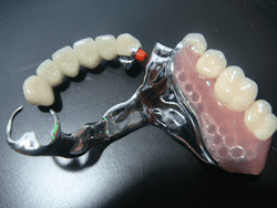 clinica-dental-noray-internacional-protesis3-0
